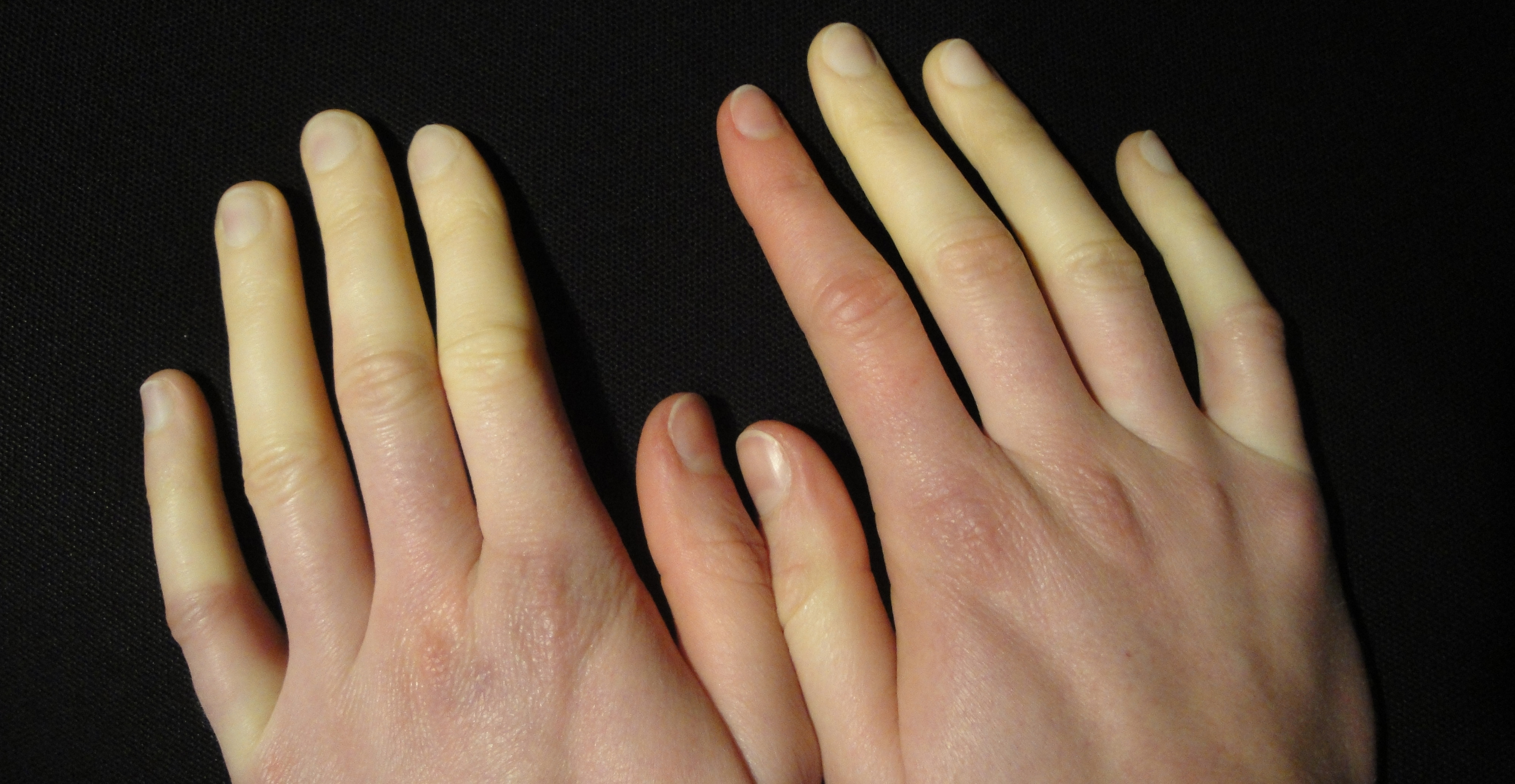 Clinical clues and treatments for Raynaud's - Medical Republic